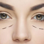 blepharoplasty moorfields london