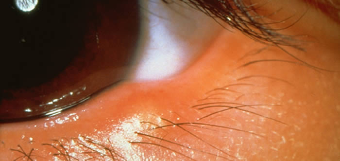 Stye