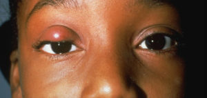 Chalazion