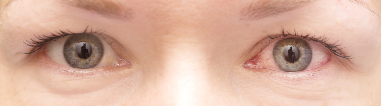 Conjunctivitis London