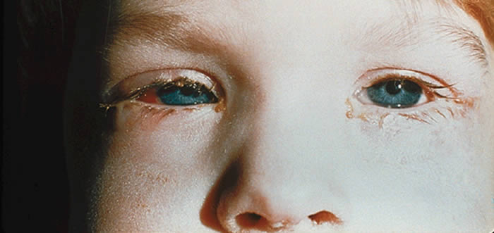 Bacterial-Conjunctiviti