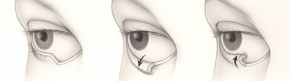 Ectropian Repair