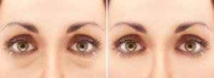 Blepharoplasty eyelid surgery procedure london