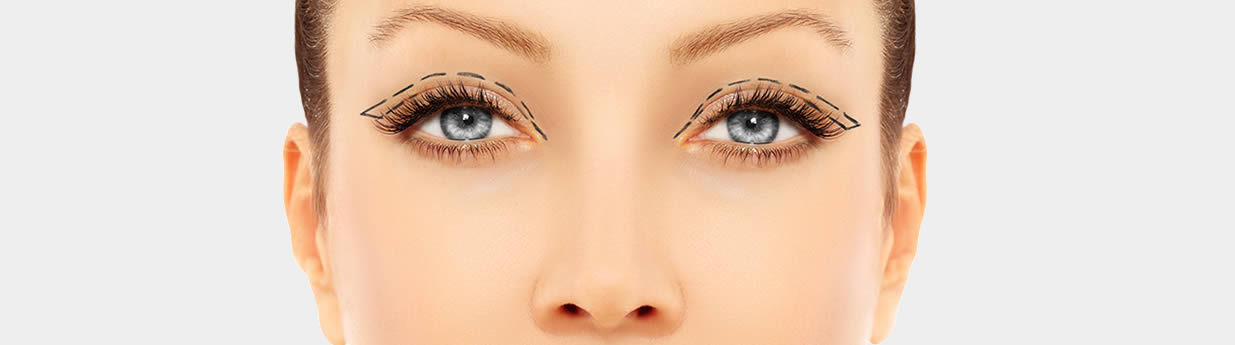Ptosis Surgery