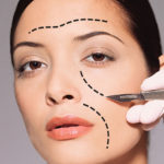 Returning the Youthful Fullness to the Cheeks — the Midface Lift