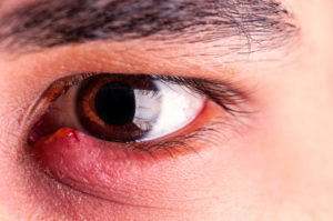 Blepharitis London W1G